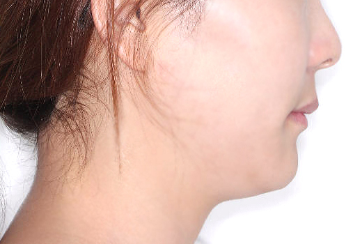 돌출입 케이스 치료 후 (AFTER)