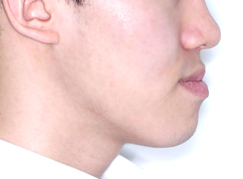 주걱턱 양악수술 병행 케이스 치료 전 (BEFORE)