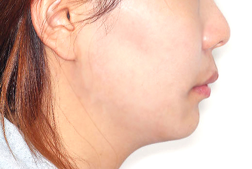 돌출입 케이스 치료 전 (BEFORE)