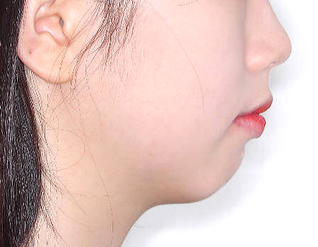 무턱 케이스 치료 전 (BEFORE)