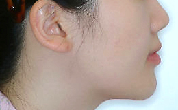 주걱턱 양악수술 병행 케이스 치료 후 (AFTER)