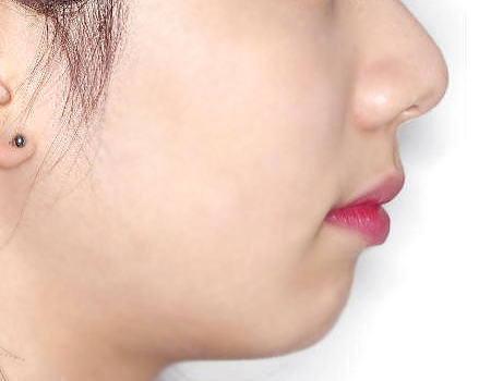 무턱 케이스 치료 후 (AFTER)