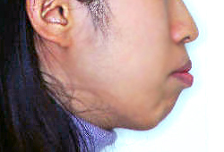 돌출입 케이스 치료 전 (BEFORE)