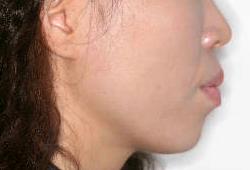 돌출입 케이스 치료 전 (BEFORE)