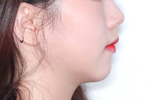 돌출입 케이스 치료 후 (AFTER)