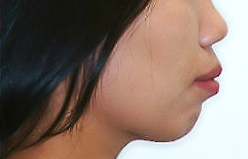 돌출입 케이스 치료 전 (BEFORE)
