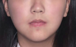 안면비대칭 수술 없이 치아교정 케이스 치료 후 (AFTER)