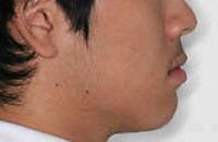 주걱턱 수술 없이 치아교정 케이스 치료 후 (AFTER)