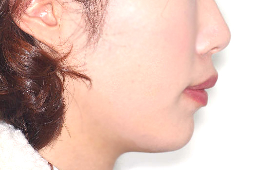 돌출입 케이스 치료 전 (BEFORE)