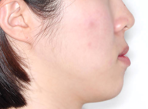 주걱턱 양악수술 병행 케이스 치료 전 (BEFORE)