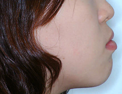 돌출입 케이스 치료 전 (BEFORE)