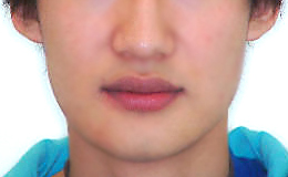 안면비대칭 양악수술 병행 케이스 치료 후 (AFTER)