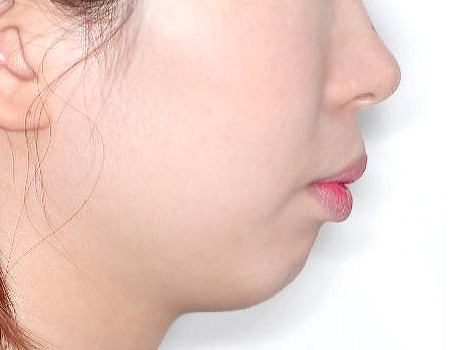 무턱 케이스 치료 전 (BEFORE)