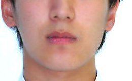 안면비대칭 양악수술 병행 케이스 치료 후 (AFTER)