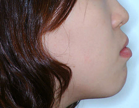 돌출입 케이스 치료 전 (BEFORE)