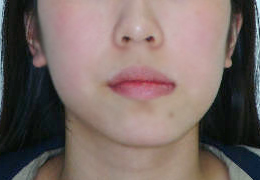 안면비대칭 양악수술 병행 케이스 치료 전 (BEFORE)