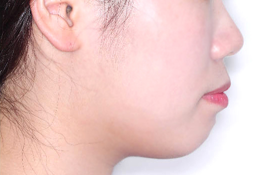 돌출입 케이스 치료 전 (BEFORE)