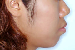 돌출입 케이스 치료 전 (BEFORE)