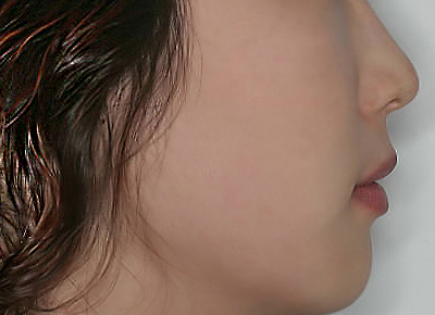 돌출입 케이스 치료 후 (AFTER)