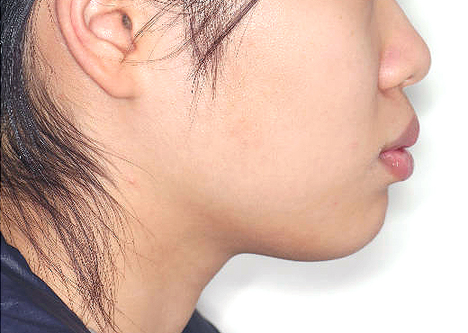 돌출입 케이스 치료 전 (BEFORE)