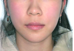 안면비대칭 양악수술 병행 케이스 치료 후 (AFTER)