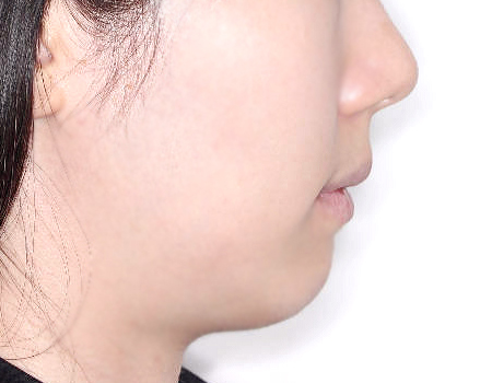 무턱 케이스 치료 후 (AFTER)