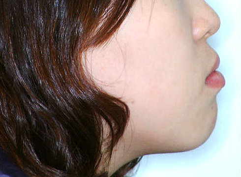 주걱턱 양악수술 병행 케이스 치료 전 (BEFORE)