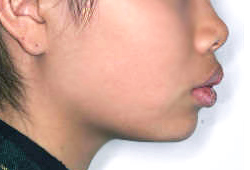 돌출입 케이스 치료 전 (BEFORE)