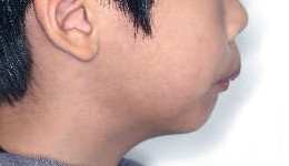 무턱 케이스 치료 전 (BEFORE)