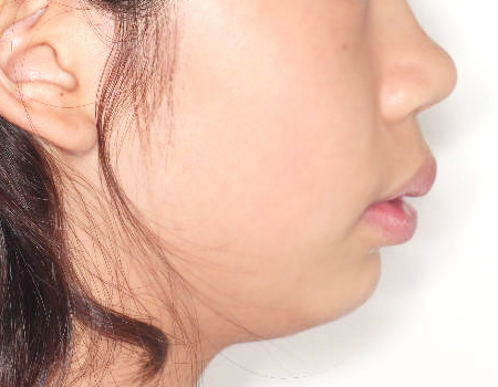 무턱 케이스 치료 전 (BEFORE)