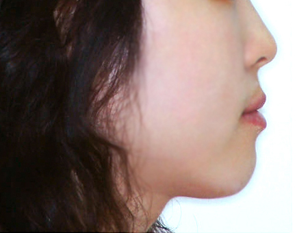 주걱턱 수술 없이 치아교정 케이스 치료 후 (AFTER)