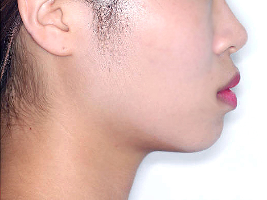 돌출입 케이스 치료 전 (BEFORE)