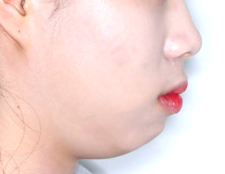 무턱 케이스 치료 전 (BEFORE)