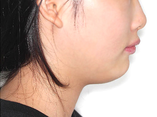 돌출입 케이스 치료 후 (AFTER)