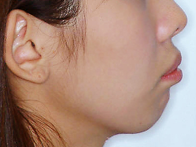 돌출입 케이스 치료 전 (BEFORE)