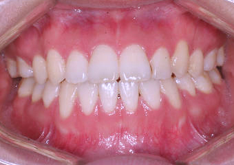 개방교합 케이스 치료 후 (AFTER)