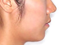 돌출입 케이스 치료 후 (AFTER)