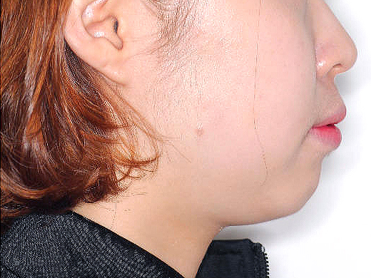 돌출입 케이스 치료 전 (BEFORE)