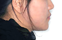 주걱턱 양악수술 병행 케이스 치료 후 (AFTER)