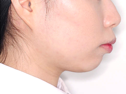 돌출입 케이스 치료 전 (BEFORE)