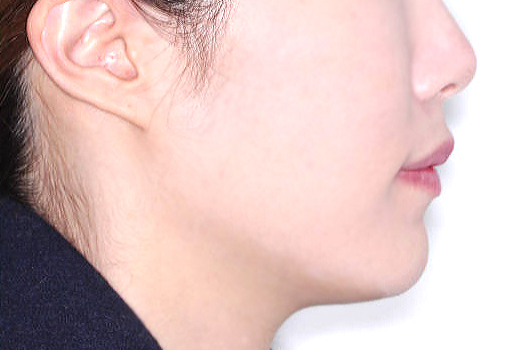 돌출입 케이스 치료 후 (AFTER)