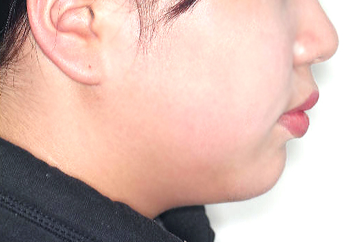 돌출입 케이스 치료 전 (BEFORE)