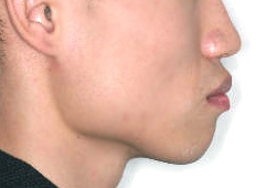 돌출입 케이스 치료 전 (BEFORE)