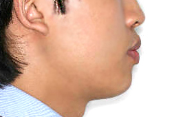 돌출입 케이스 치료 전 (BEFORE)