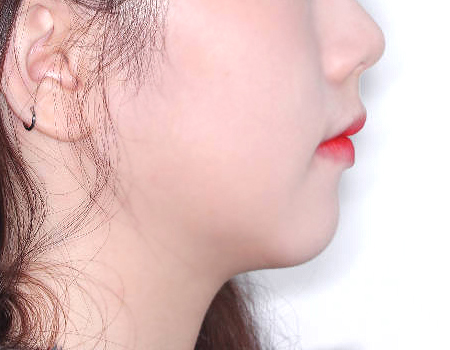 무턱 케이스 치료 후 (AFTER)