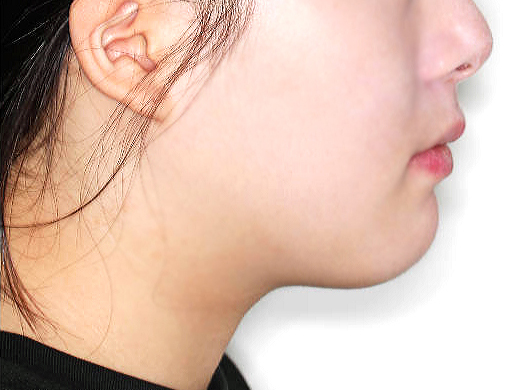 돌출입 케이스 치료 후 (AFTER)