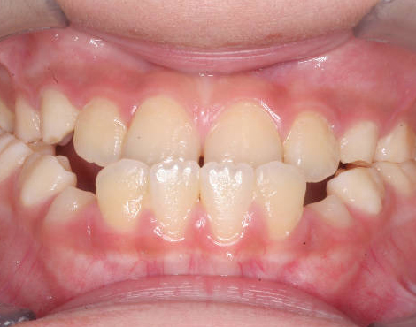 주걱턱 수술 없이 치아교정 케이스 치료 전 (BEFORE)