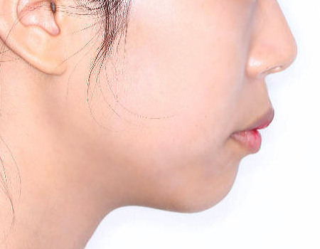 무턱 케이스 치료 전 (BEFORE)
