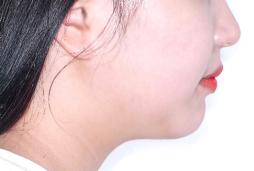 돌출입 케이스 치료 후 (AFTER)