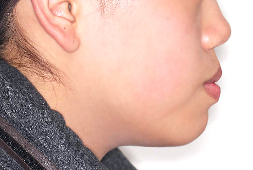 돌출입 케이스 치료 전 (BEFORE)